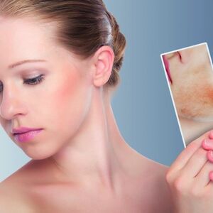 Atopijski dermatitis - tesna koža