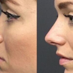 Korekcija nosa bez operacije: Novi lepši nos gotov za 5 minuta!