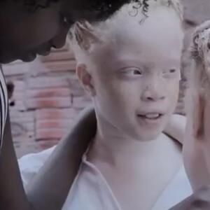 Sestre koje oduzimaju dah: Upoznajte albino bliznakinje koje su napravile pravu revoluciju u svetu mode! (FOTO)