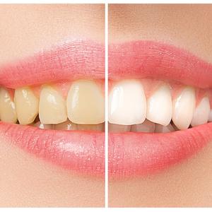 BUDITE PONOSNI NA SVOJ OSMEH: Na ovaj potpuno prirodan način vratićete belinu zubima i oduševiti se rezultatima!