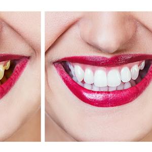 ZAPOČNITE DAN SA OSMEHOM: U rekordnom roku izbelićete zube na ovaj potpuno bezbedan način!