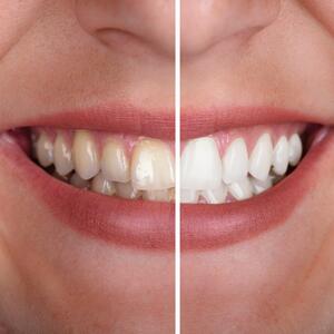 VELIKO SNIŽENJE POVODOM DANA ZALJUBLJENIH: Učinite vaše zube savršeno belim, jer BAŠ SADA je pravi trenutak za osmeh!