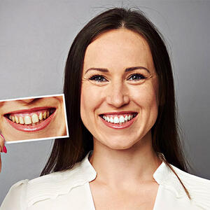 ORALNO ZDRAVLJE I ESTETIKA: Mogu li se zubi stvarno izbeliti BEZBEDNO u kućnim uslovima?