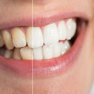 SJAJAN TRIK ZA LEPŠI OSMEH: Potrebno vam je svega 16 minuta za biserno bele zube!