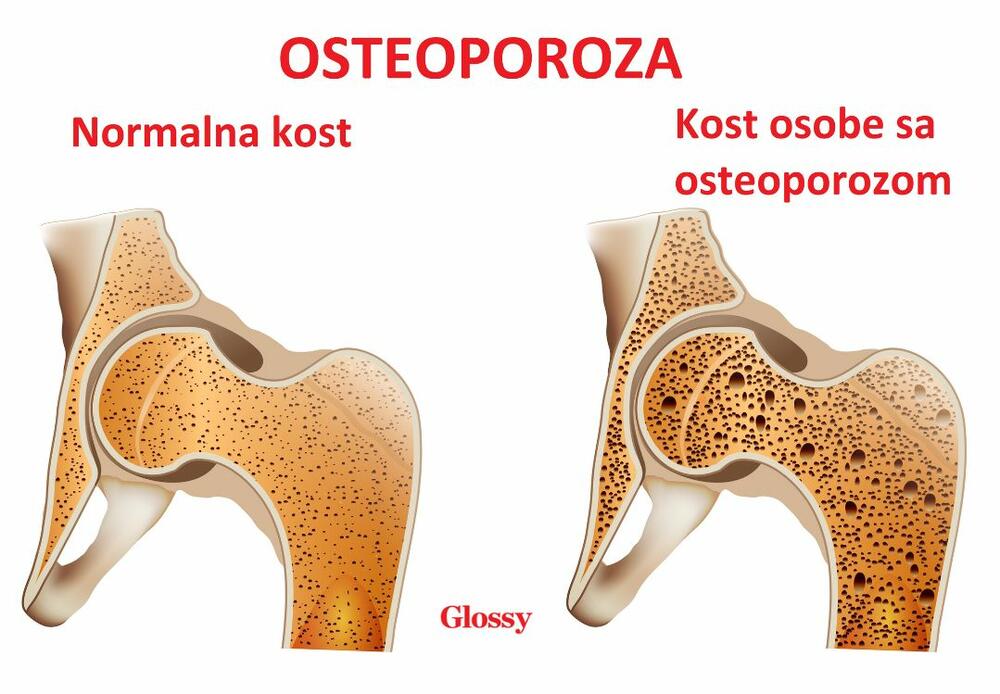 Osteoporoza češće pogađa žene nakon menopauze zbog pada estrogena