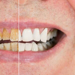 Uklanja mrlje sa zuba i vraća im belinu: Ova sitnica može da vam pomogne da imate blistav osmeh
