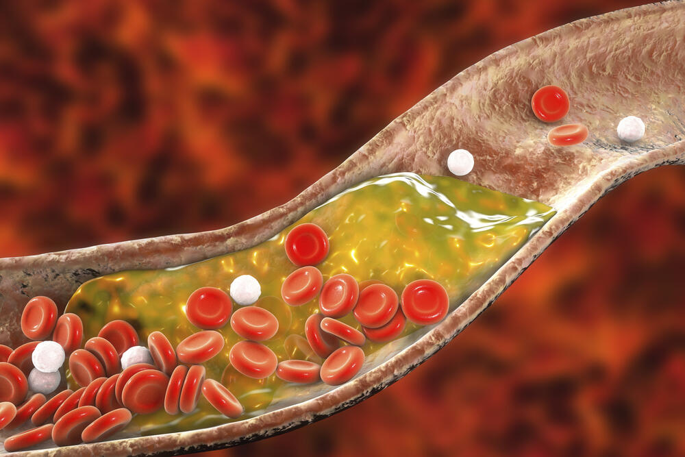 nakupljanje holesterola u krvnim sudovima