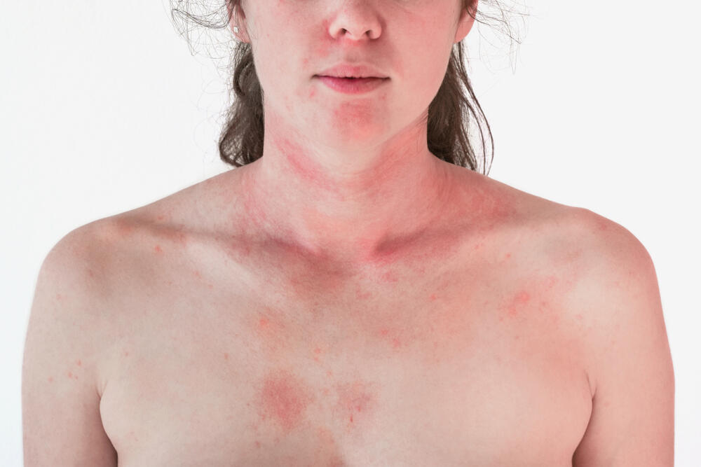 Alergija, Alergijska reakcija, Crvenilo kože