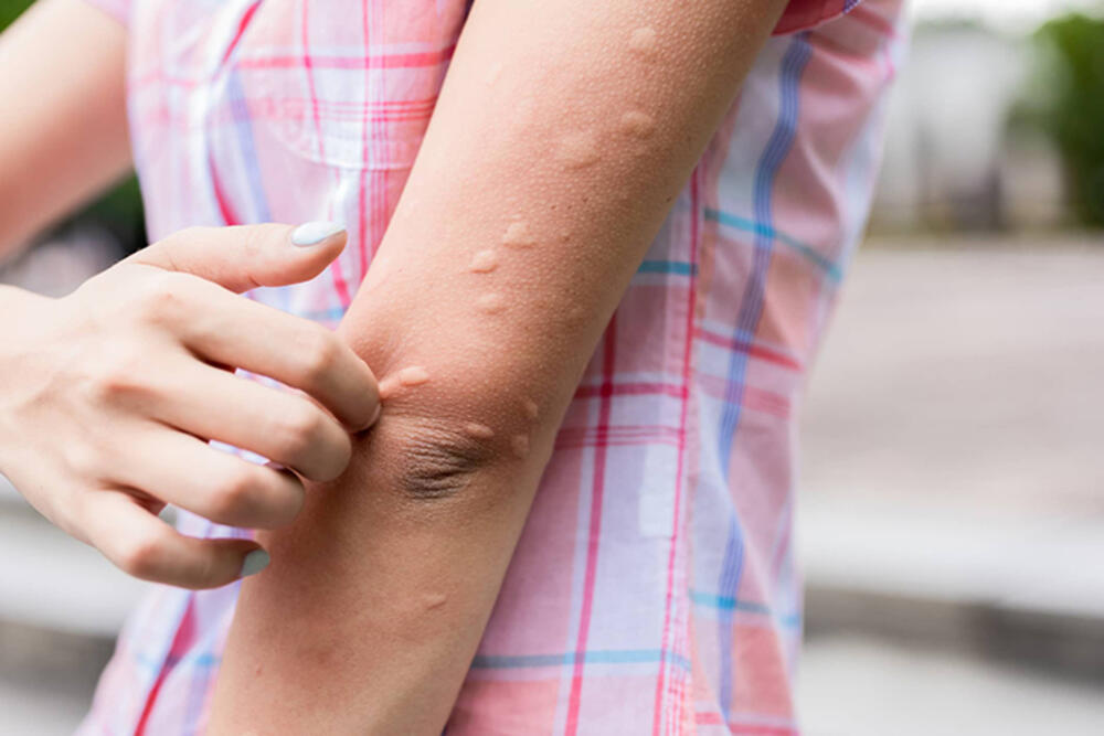 ugljen-dioksid, bakterije, miris na koži samo su neki od razloga zbog kojih možda privlačite komarce više od ostalih