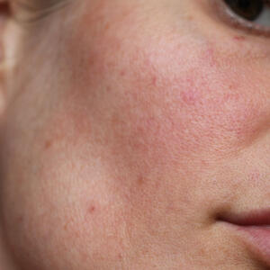 Kako ukloniti TAMNE FLEKE s kože? 3 prirodna trika za brisanje mrlja od sunca, akni i starenja