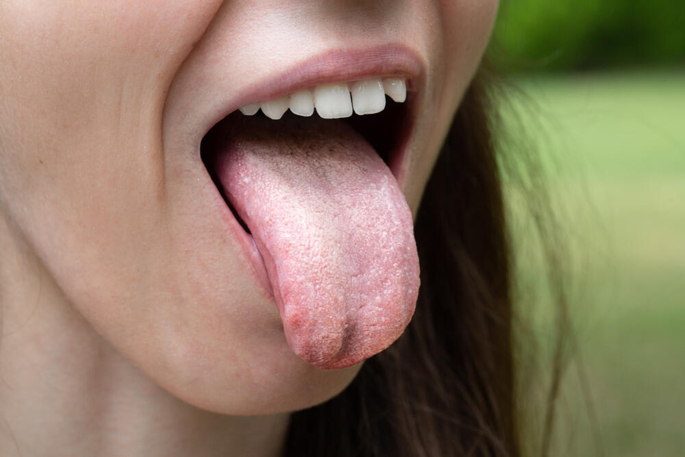 Kandida u ustima prepoznaje se po beličastoj boji jezika