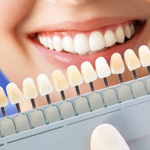 Kako da izbelite zube do dočeka Nove godine? Evo šta vam može pomoći da imate NAJBLISTAVIJI OSMEH IKADA