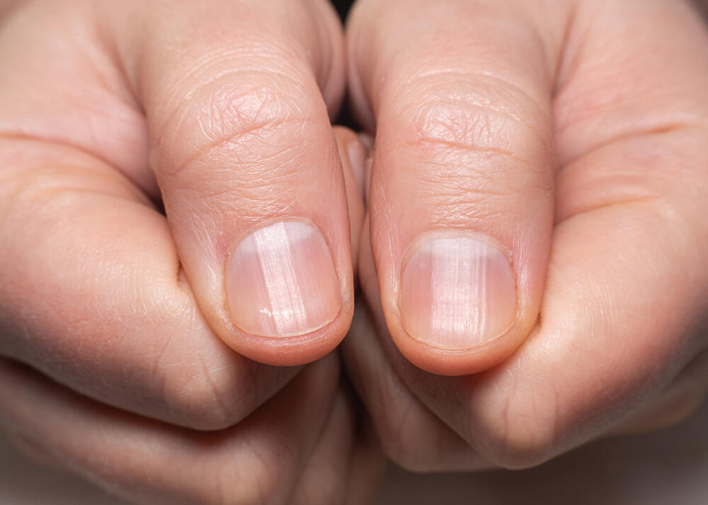 U jako retkim situacijama, žuti nokti mogu ukazivati na rak kože