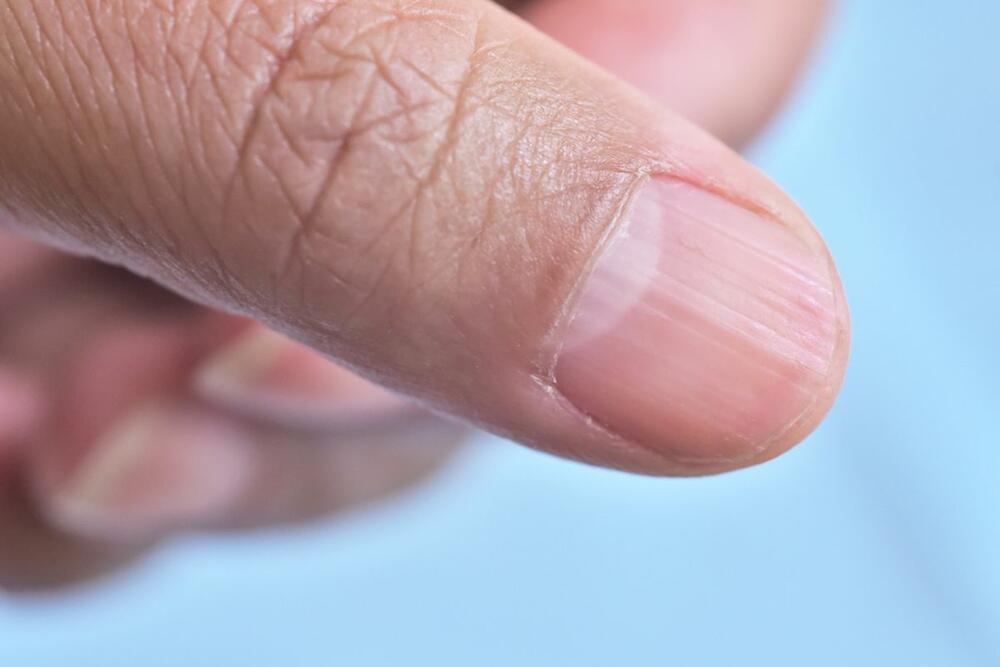 šta znače vertikalne linije na noktima?