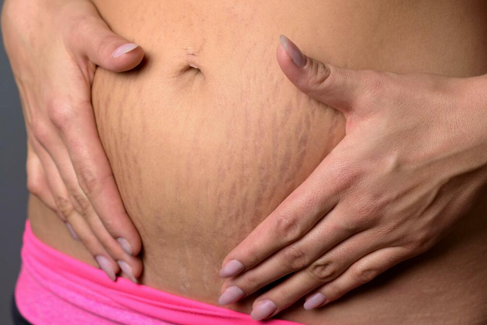 strije na stomaku posle porođaja