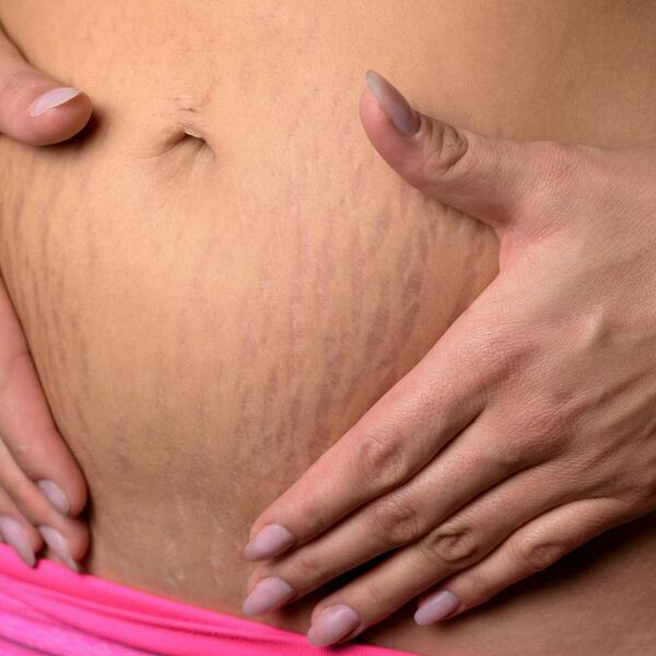 Strije posle trudnoće: Pogledajte na koji način ih možete smanjiti i ublažiti