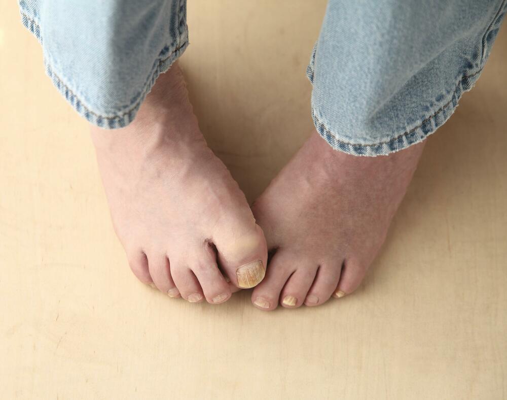 gljivice na stopalima mogu da budu vrlo uporne