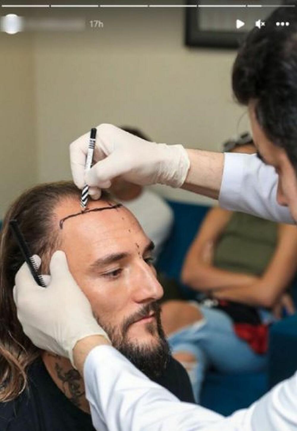 Nemanja Gudelj na klinici za presađivanje kose u Turskoj