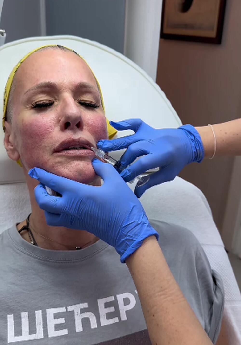 Tijana Dapčević na tretmanu za lice i ubrizgavanju hijaluronskih filera u usne