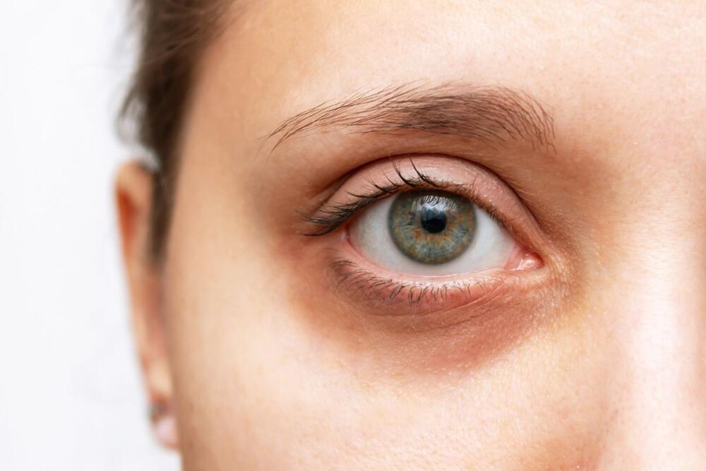Tretman za podmlađivanje regije oko očiju bira se u skladu s tipom podočnjaka