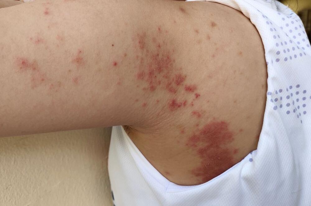 Osip usled atopijskog dermatitisa