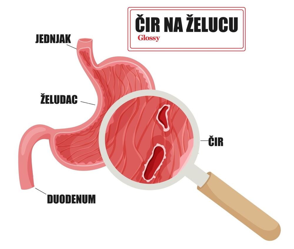 Čir na želucu ima jedan karakterističan simptom