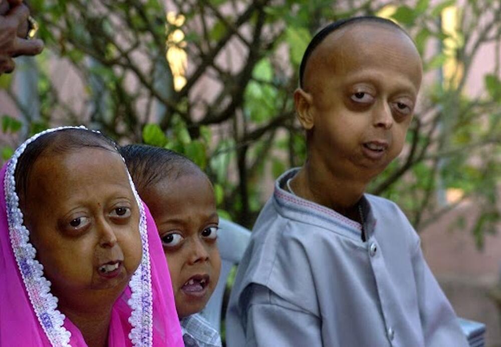 Porodica Kan u Kalkuti pogođena je progerijom