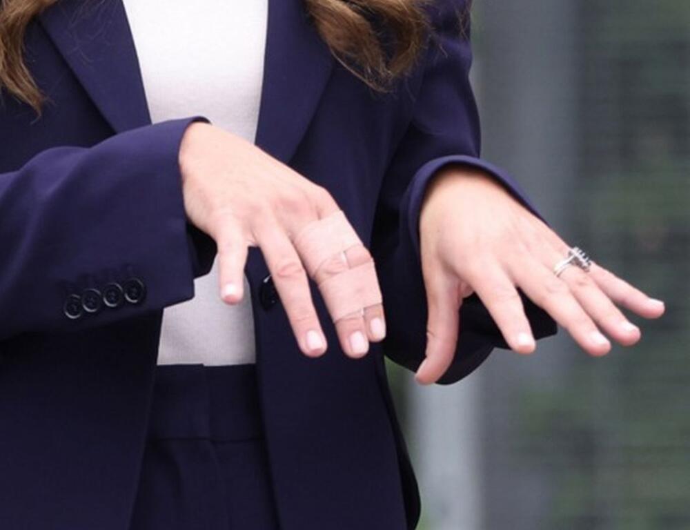 Prsti Kejt Midlton često su uvijeni u zavoje ili flastere u boji kože