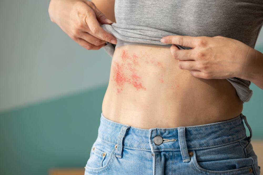 Herpes zoster se na koži manifestuje crvenilom, osipom, plikovima...
