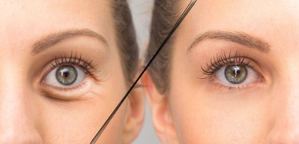 Pre i posle primene kreme za predeo oko očiju (ILUSTRACIJA)