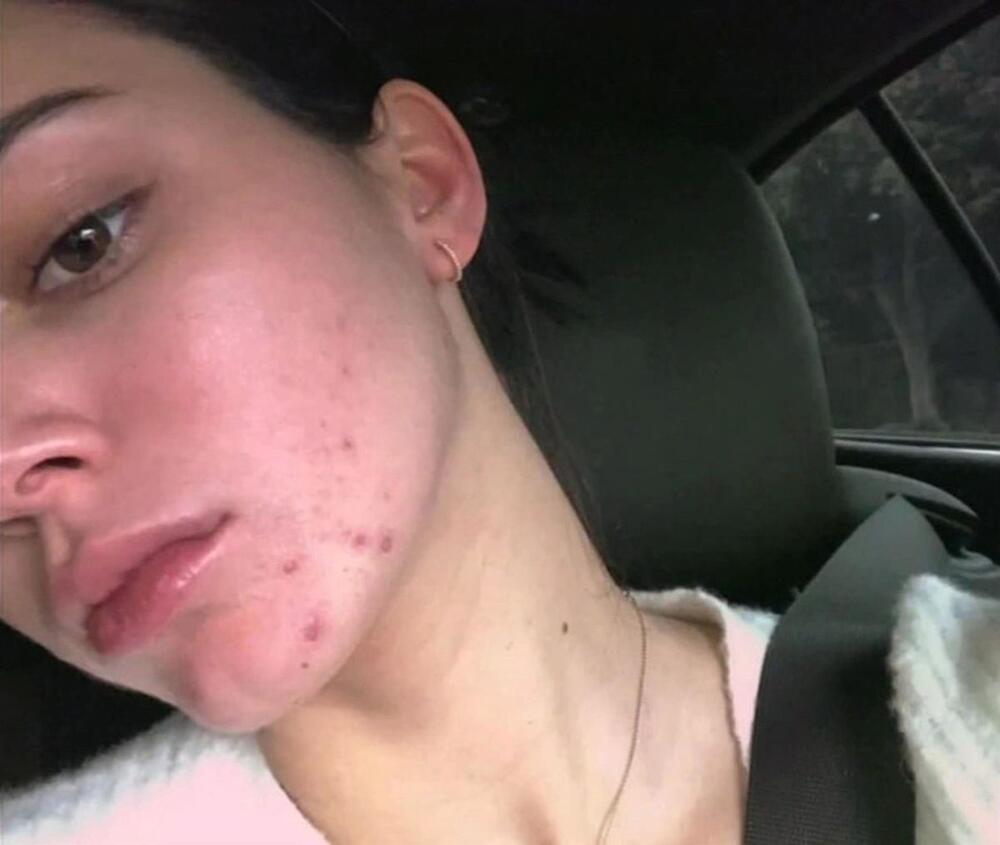 Kendal Džener otvoreno je pričala o svom problemu s masnom kožom i sklonosti aknama