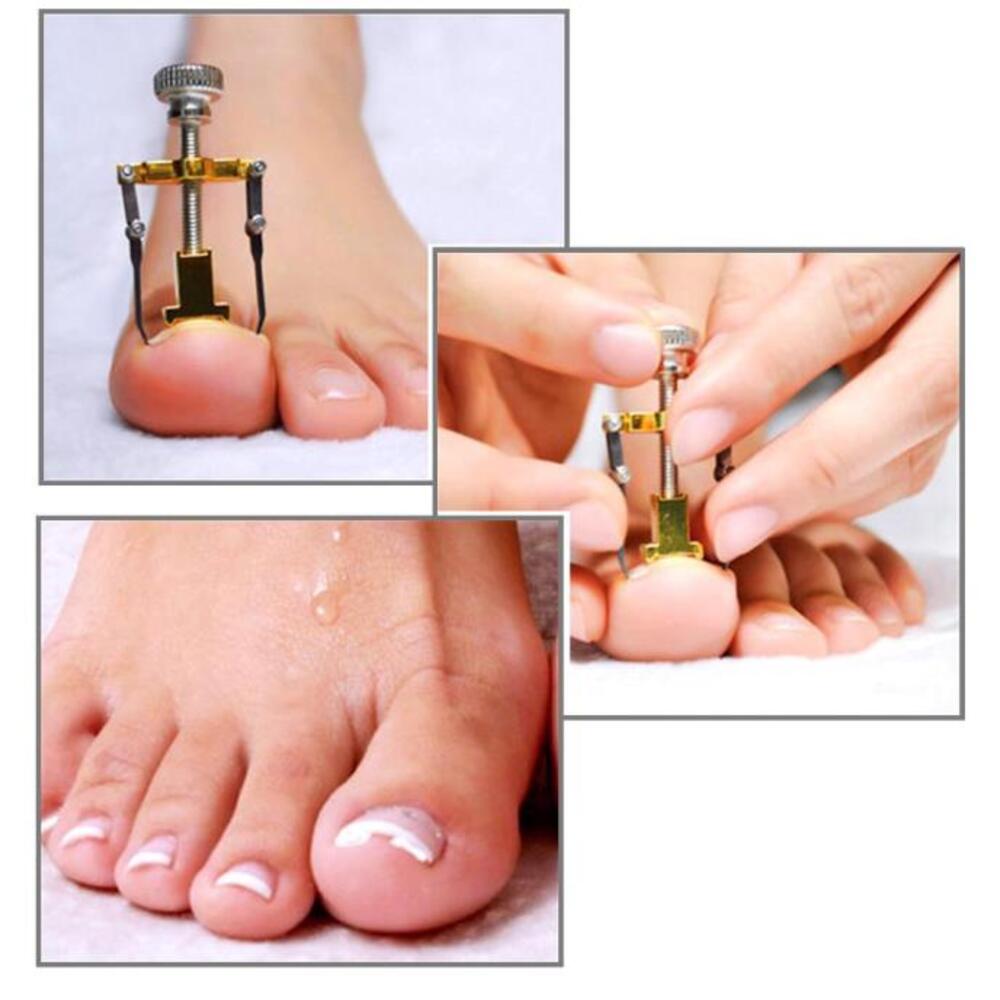 ALAT ZA URASLE NOKTE 