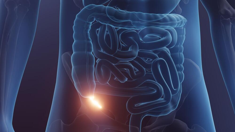 Upala slepog creva, tj. crvuljka