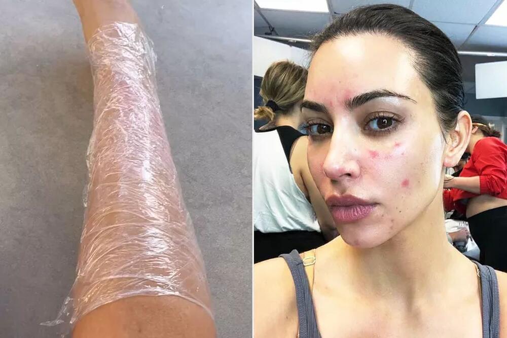 Kim Kardašijan otvoreno je pričala o svom životu sa psorijazom
