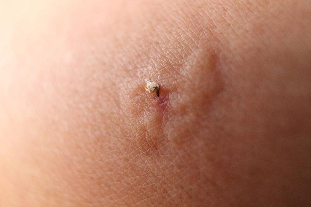 Morate da znate da li ste alergični na ujed ose ili pčele