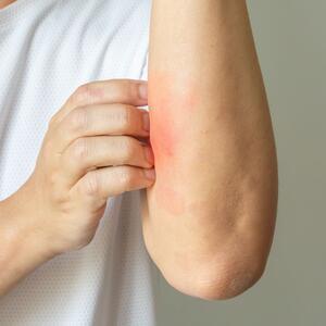 Kako razlikovati ujede različitih insekata? Evo kako da prepoznate kada obavezno treba da se javite lekaru