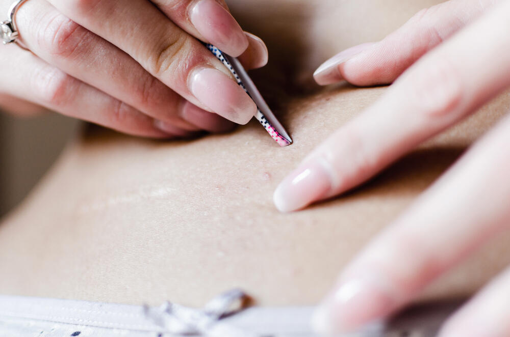 Da bi se urasle dlake iščupale, važno je da se koža omekša