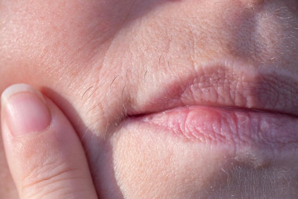 Pojačana maljavost može da ukaže na sindrom policističnih jajnika