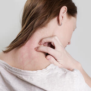 Kako izgleda šuga i koji su njeni simptomi? Ne samo što još postoji nego se pojavila u Beogradu, a prepoznaje se lako