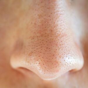 5 stvari koje stvarno morate da znate ako imate mitesere: Poslednja će vas iznenaditi, a sve će pomoći da ih se rešite