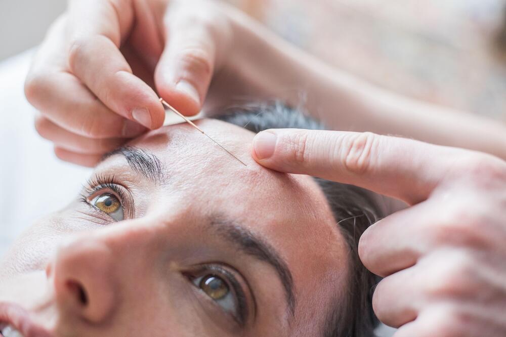 Estetska akupunktura lica poboljšava izgled, smanjuje bore i fine linije i oblikuje lice