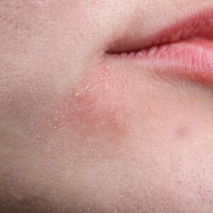 Može da bude zdravstveni ili emocionalni problem: Ako vam je koža uvek suva na istim mestima, recite to lekaru