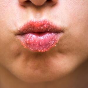 Ispucale su vam usne? Evo kako brzo i jednostavno možete da napravite piling kod kuće od samo 2 sastojka