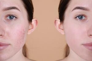 Ove kreme dokazano brišu ožiljke: Strije i tragovi od akni i povreda mogu da budu prošlost ako ih mažete redovno