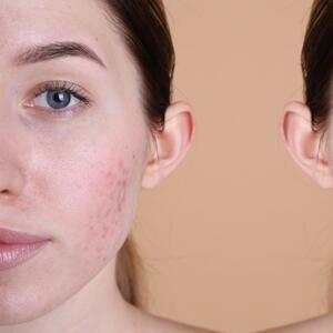 Ove kreme dokazano brišu ožiljke: Strije i tragovi od akni i povreda mogu da budu prošlost ako ih mažete redovno