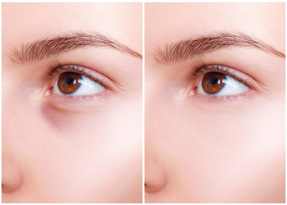 Predeo oko oka pre i posle šminkanja ciljanog na neutralisanje i prekrivanje podočnjaka i tamnih kolutova