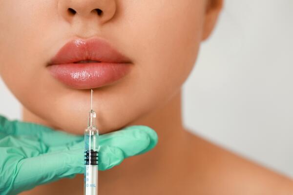 Sve što vas zanima o povećanju usana filerima: Doktorka za Glossy otkriva je li bolno, koliko košta i kako se spremiti