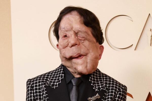 Zvali su ga Kvazimodo, Ožiljak i Čovek-slon: Glumac o kom se najviše priča posle Oskara je junak neverovatne priče