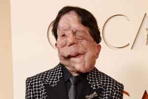 Zvali su ga Kvazimodo, Ožiljak i Čovek-slon: Glumac o kom se najviše priča posle Oskara je junak neverovatne priče