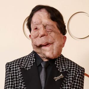 Zvali su ga Kvazimodo, Ožiljak i Čovek-slon: Glumac o kom se najviše priča posle Oskara je junak neverovatne priče